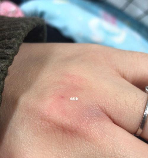被家养狗咬了怎么办？（应对狗咬事件的有效方法）