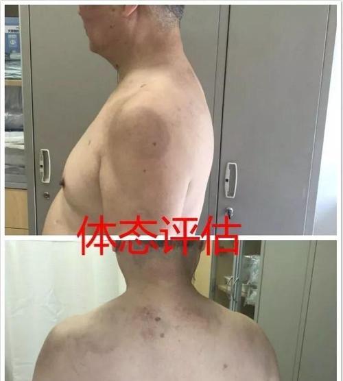 狗狗肩关节错位手术（探索狗狗肩关节错位手术的必要性、手术过程和康复要点）